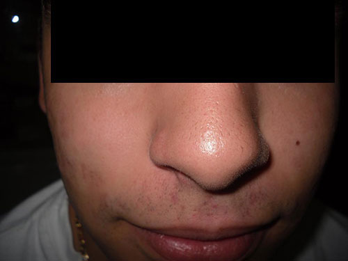 dermatólogos acné