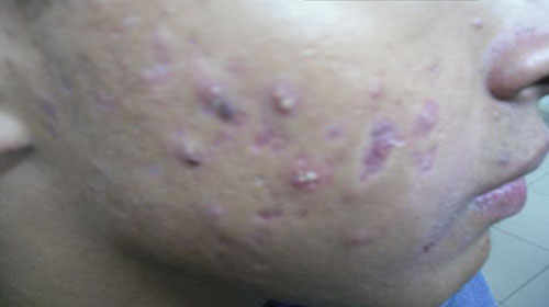 dermatologos acné