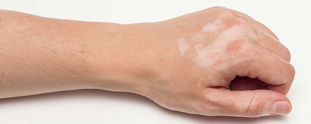 vitiligo dermatologo